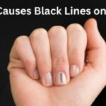 Why Do Black Lines Appear on Nails?